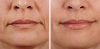 Before and After Lip Enhancement
