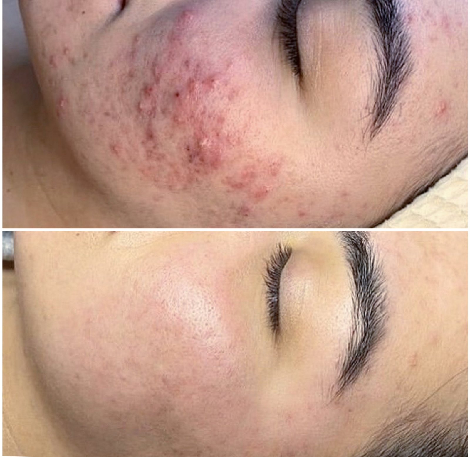 Skin Peel Before & After