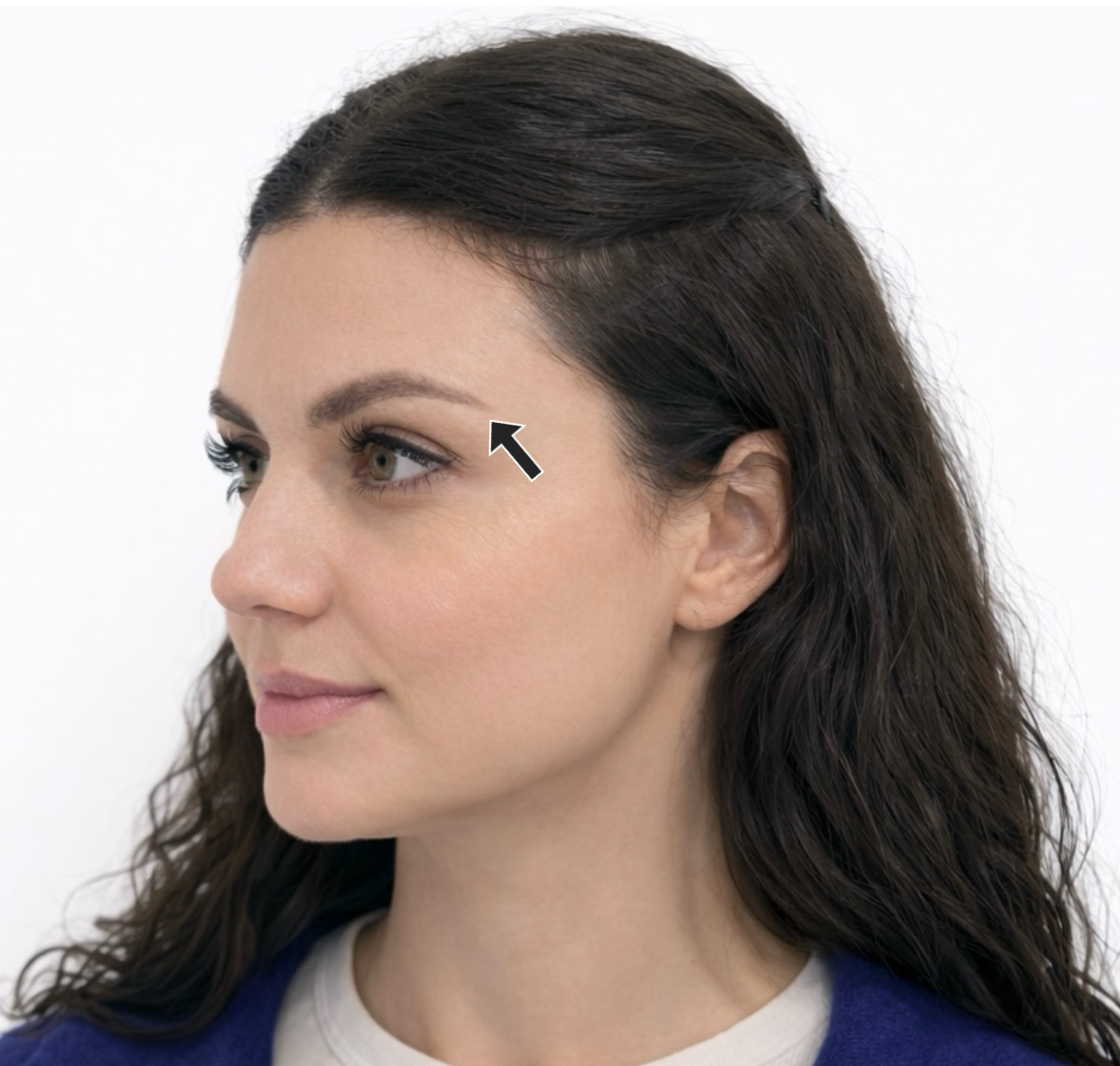 Brow lift